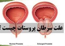 همگام با بسیج ملی مبارزه با سرطان؛ سرطان پروستات چیست؟